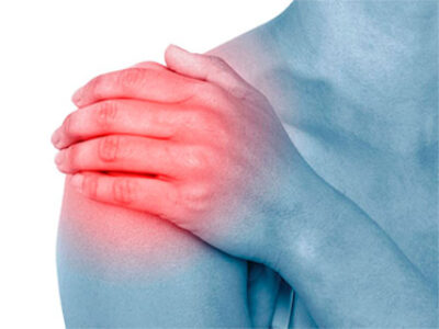 La lussazione della spalla è una fuoriuscita completa della spalla dalla sua sede naturale a seguito di sintomi di instabilità.