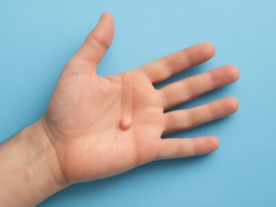 il nodulo sul palmo della mano di un giovane uomo