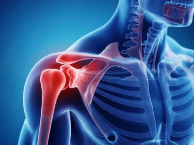 l'intervento di protesi alla spalla su un uomo